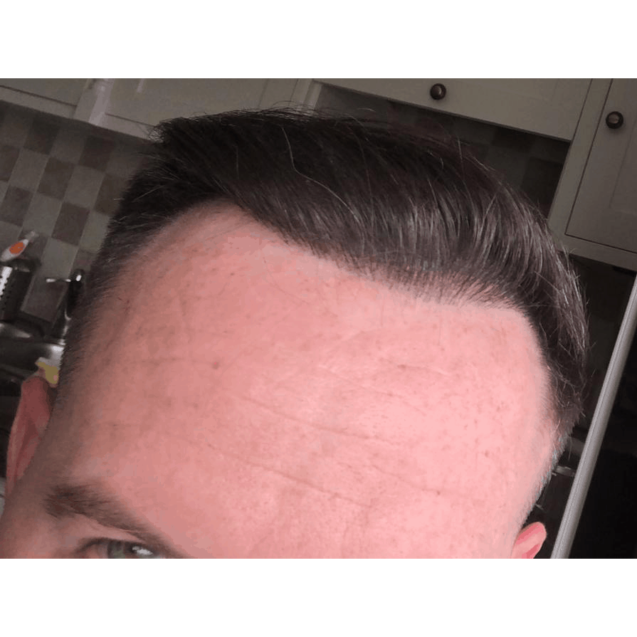 Hair Loss Hair Loss