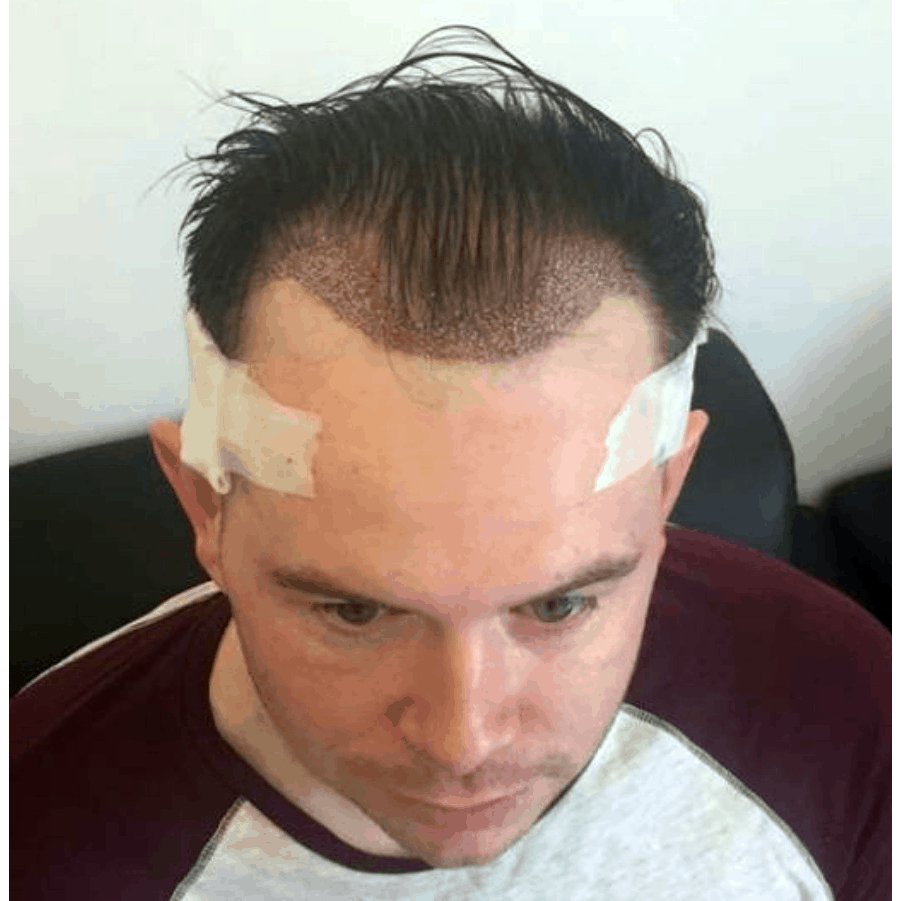 Hair Loss Hair Loss